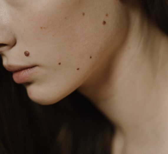 Red moles on skin – find out what should you know about them