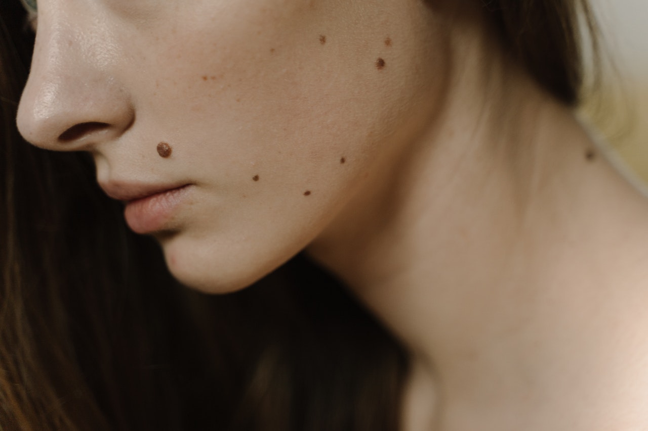 Red moles on skin – find out what should you know about them
