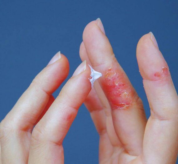 How to understand your skin and reduce flare-ups of eczema and psoriasis