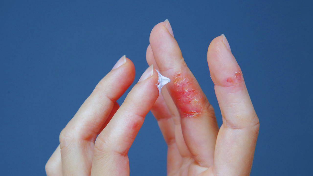 How to understand your skin and reduce flare-ups of eczema and psoriasis